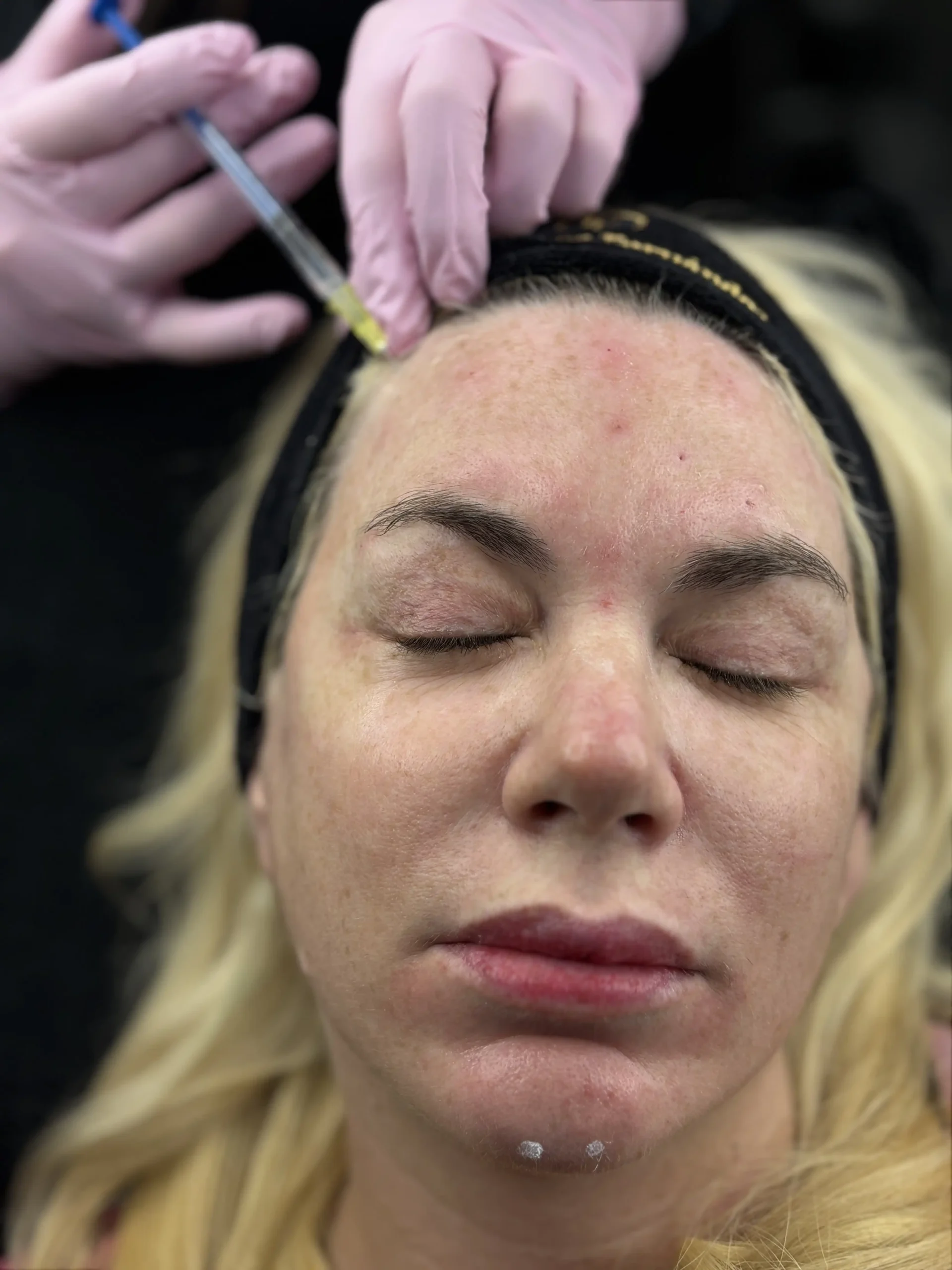Resultados de Botox Facial