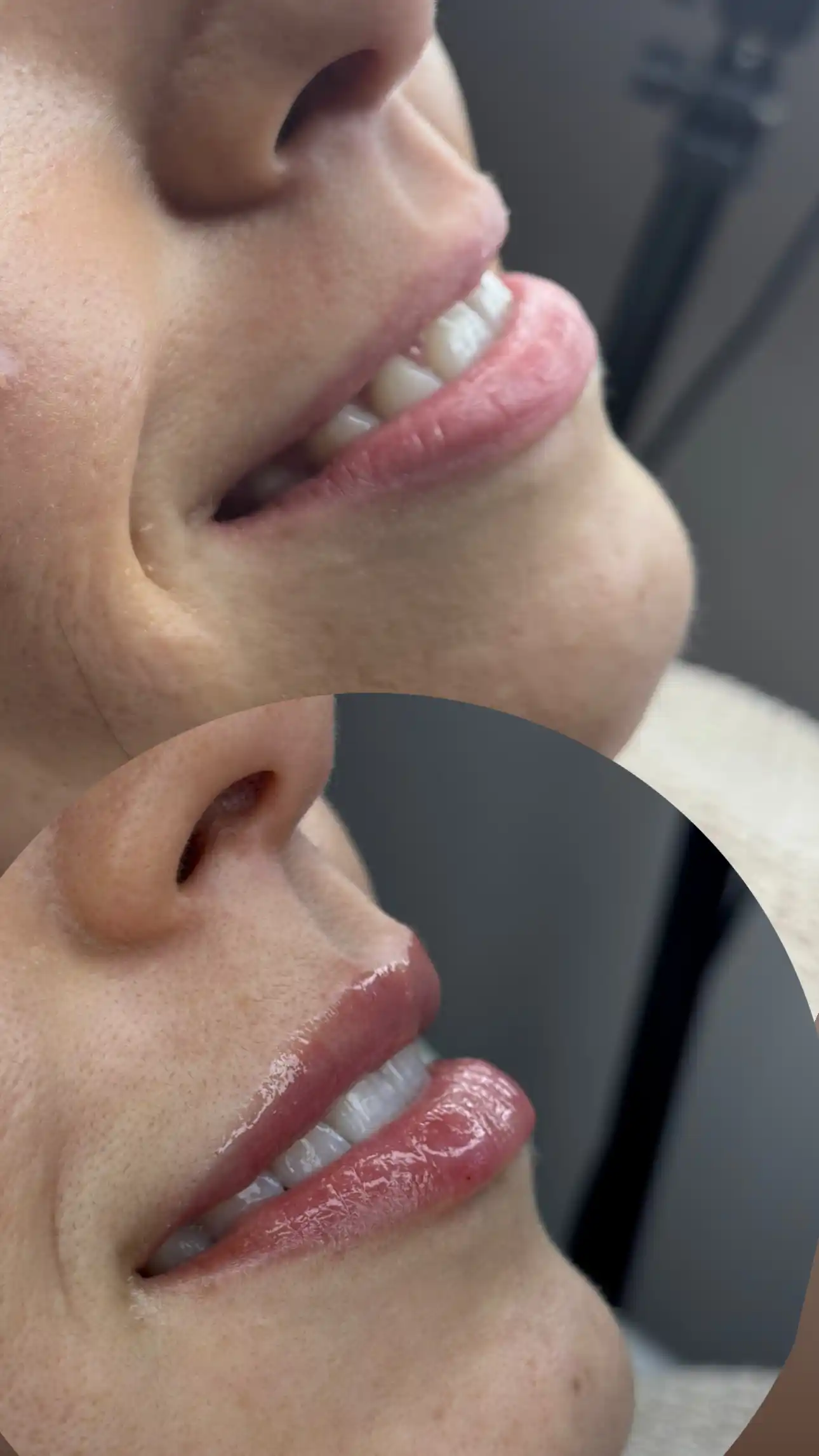 Estética de Labios - Detalle Estructural