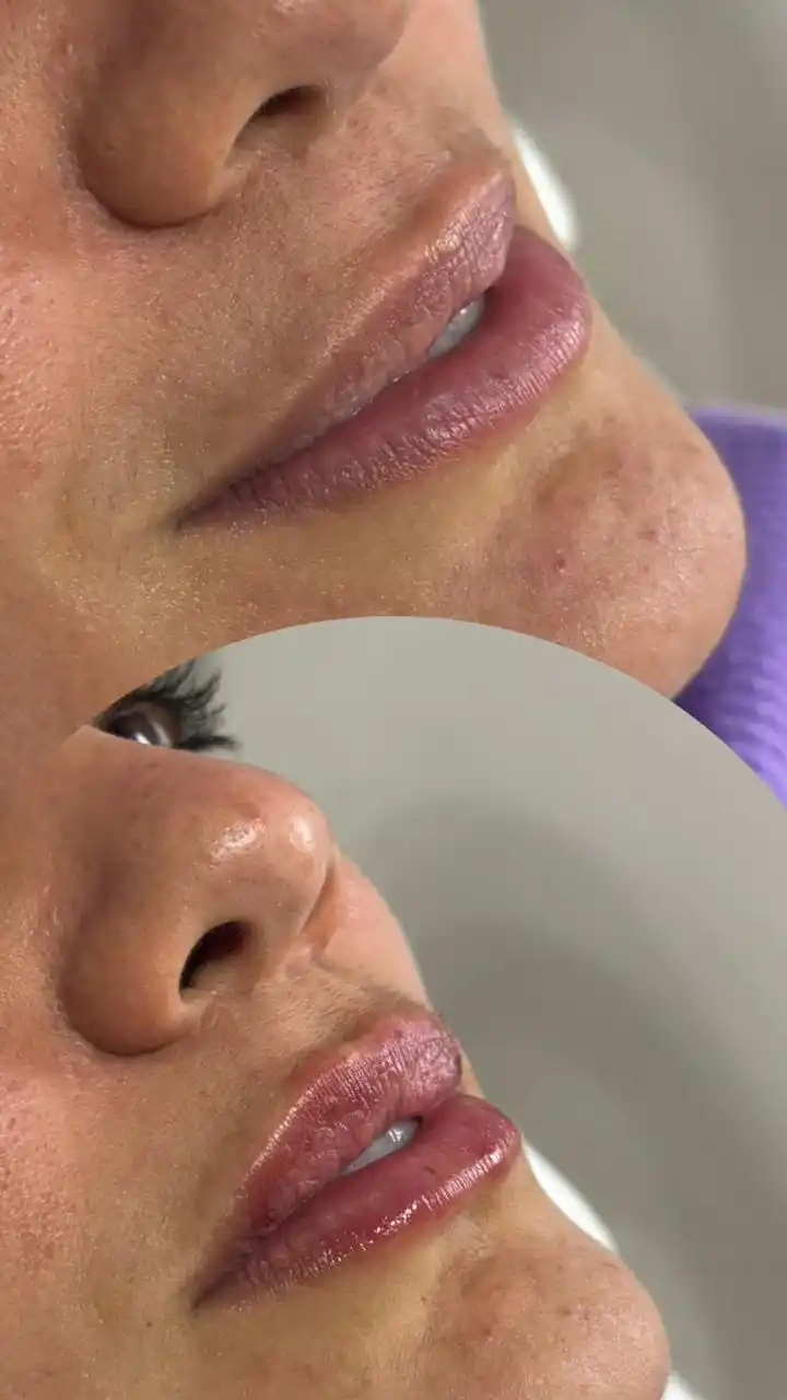 Estética de Labios - Resultado Clínico